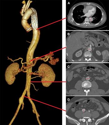 Staging reinterventions for remodeling of residual aortic dissection: a single-center retrospective study